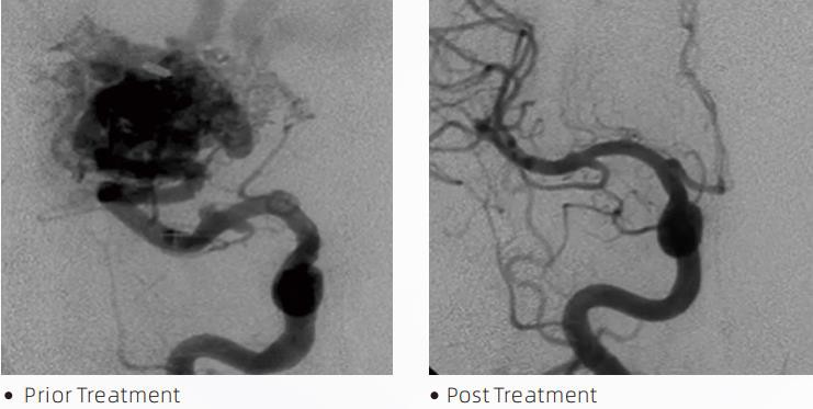 endovascular clot retrieval stroke